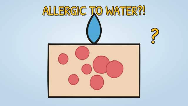 Munchrd: Why are a few people genuinely allergic to water?